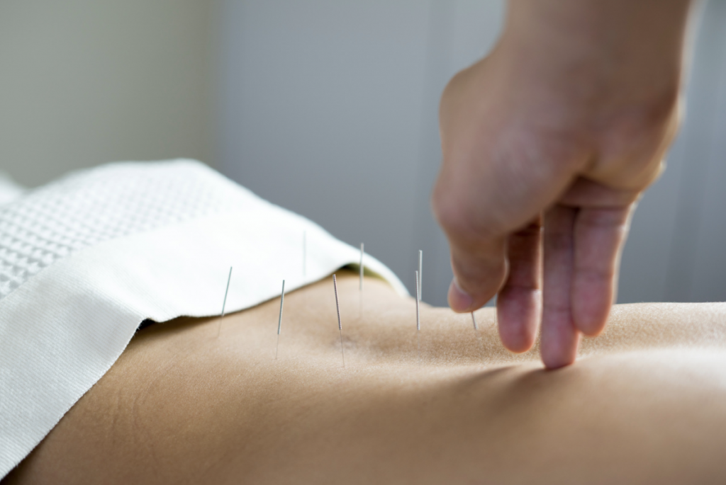 Acupuncture