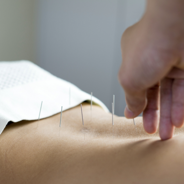 Acupuncture